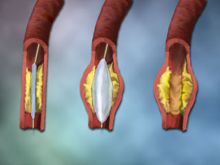 Perkutana angioplastika pri zdravljenju diabetičnega stopala